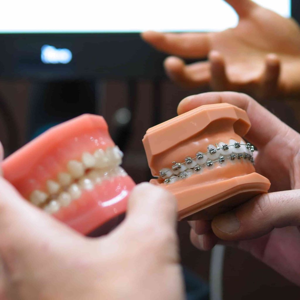 Orthodontic Treatment at Apollonia Dental7